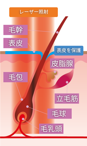 レーザー照射